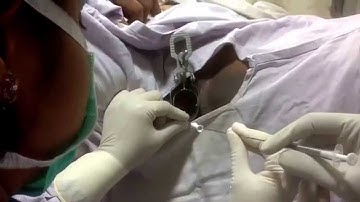 Embryo Transfer Procedure in IVF under USG Guidance | ARC Chennai