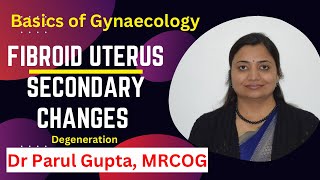 Fibroid uterus : Secondary changes | Degeneration |