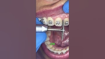 Orthodontic treatment/IPR/lets smile beautifully🥰.IPR.Fixed braces🥰