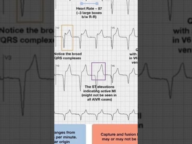 Accelerated idioventricular rhythm on the ECG. class=