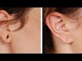 Permanent ear hole recovery with 100 result  by new beauty junction 