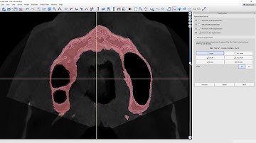 Bone Segmentation of a Difficult Maxilla in Blue Sky Plan