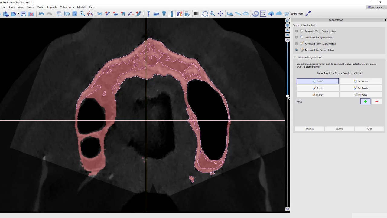 Bone Segmentation of a Difficult Maxilla in Blue Sky Plan