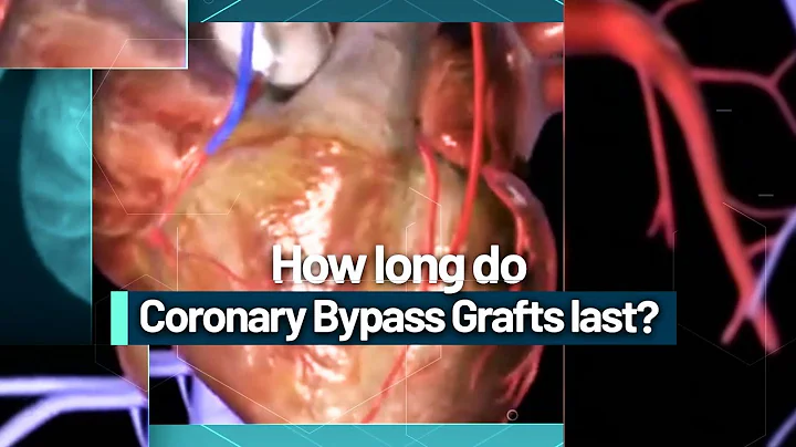 How long do Coronary Bypass Grafts last?