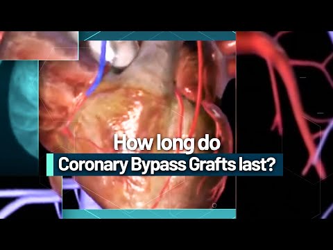 How long do Coronary Bypass Grafts last?