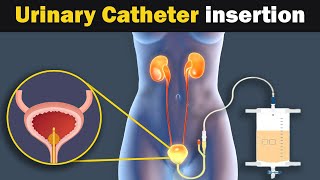 Foley Catheter insertion and purpose | Animation |