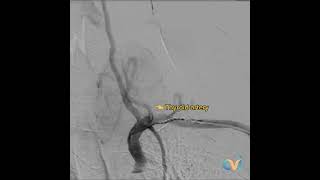 Live Thyroid Goiter Embolization Treatment