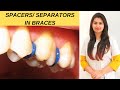 What Are Separators/ Spacers In Braces & How Are They Put On? | What is the first step in braces?