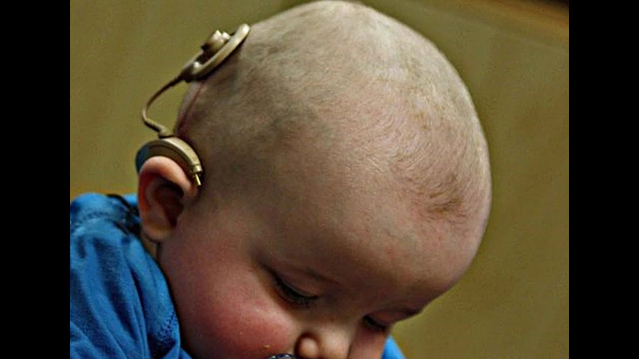 Cochlear Implant Surgery Parents Interview held on 24-6-2025 in CMH RWP from Gilgit Baltistan