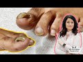 Tutorial on how to care  treat a detached toenail with a pedicure