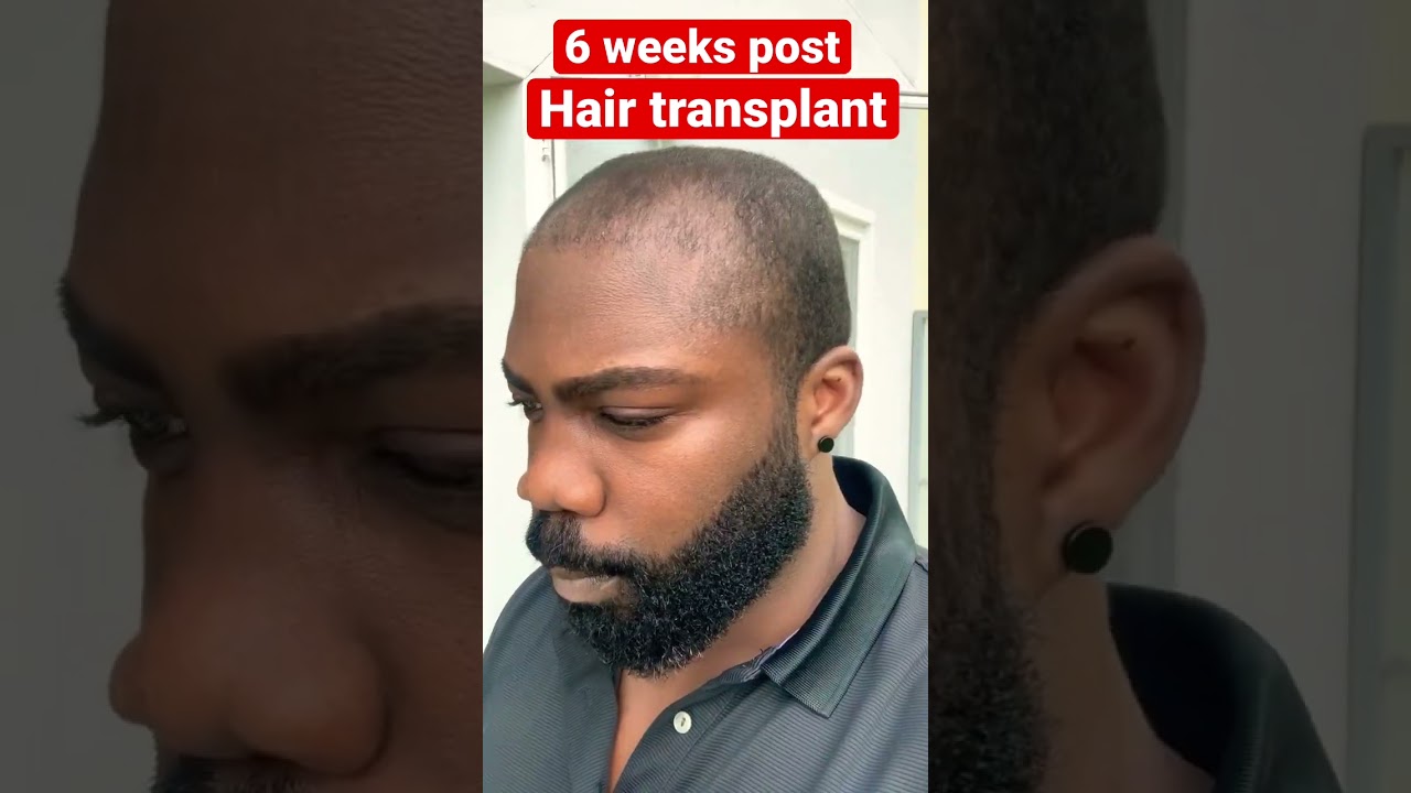 6 weeks post DHI hair transplant. 5,000 graphs. Asli Tarcan 
