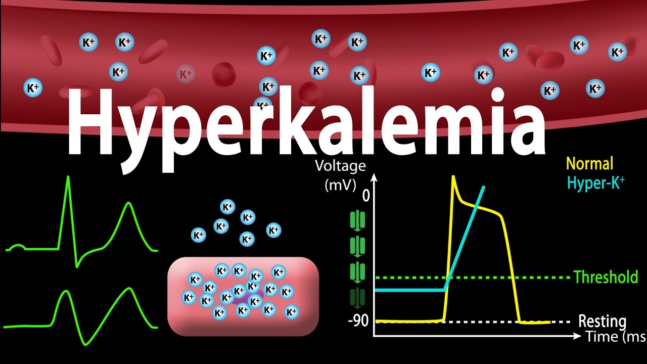 Image result for Hyperkalemia