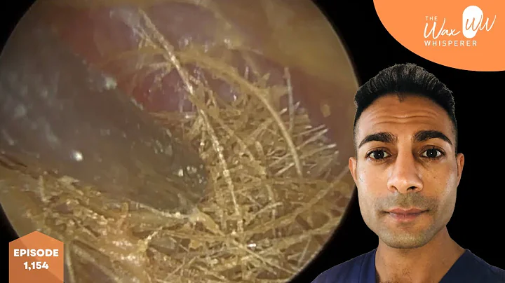 1,154 - Stuck Woven Ear Hairs Nest Removed off Inf...