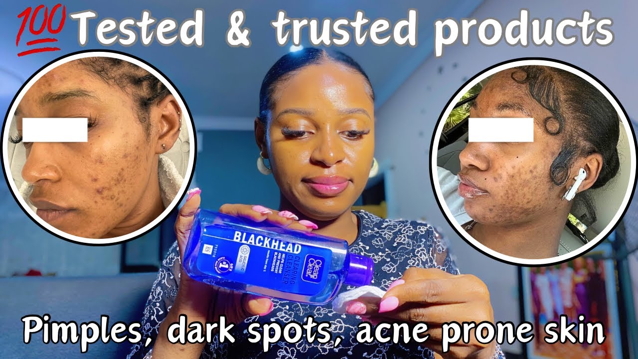 tested-trusted-best-products-for-pimples-acne-affordable