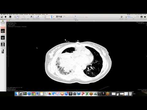 Lymphangioleiomyomatosis presenting as Spontaneous Pneumothorax