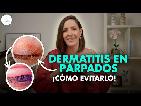 Video: ¿Se puede propagar la dermatitis periocular?