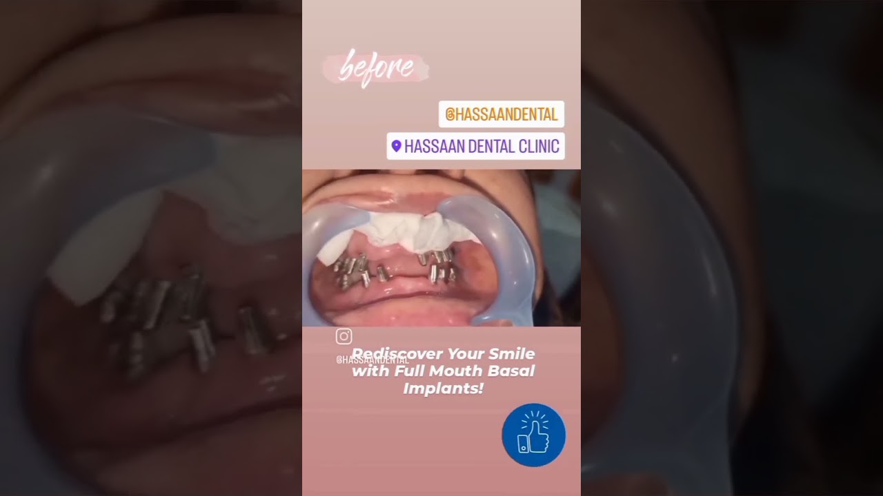 Revitalise your smile with Full Mouth Basal Implants!✨😁 