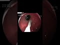Endoscopic Removal Of Marble Ball From Stomach