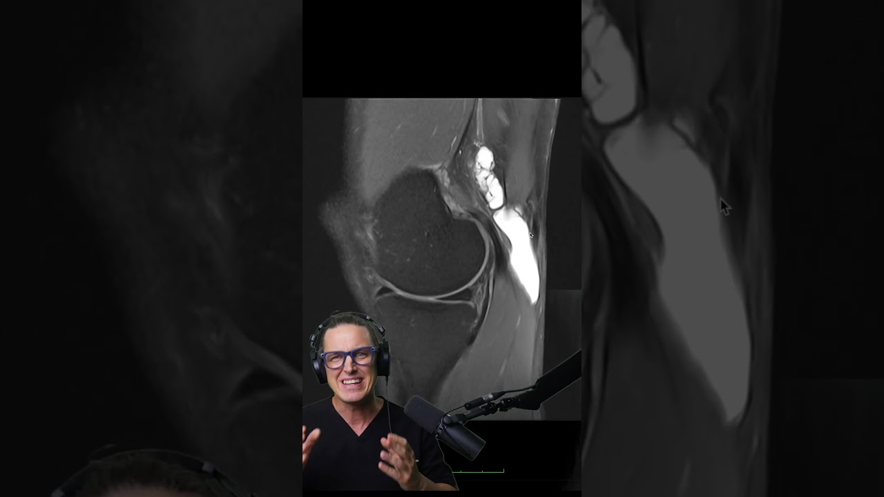 Warum Baker-Zysten in deinem Knie entstehen – und was dahintersteckt