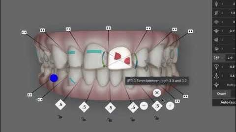 Invisalign Planning Tip! How to close upper front diastema (gaps) with orthodontics