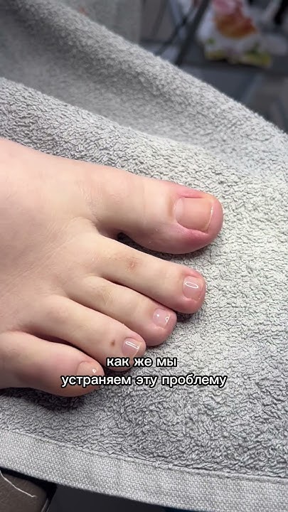 Вросшие ногти #ногти #педикюр#вросшиеногти - YouTube