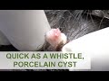 Quick as a Whistle, Porcelain Cyst | Dr. Derm