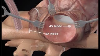 CoxMaze IV Procedure Animation for Surgical Ablation