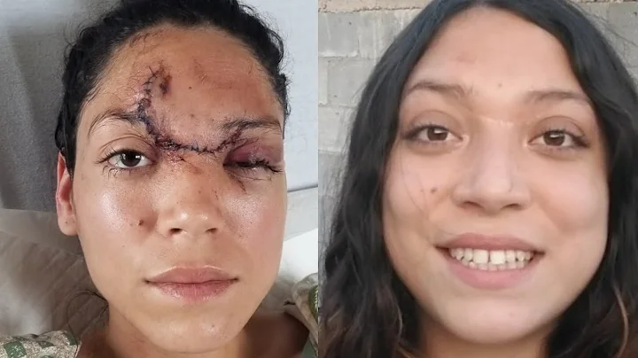 1 YEAR POST OP *FORHEAD LACERATION* // PERLA RAMIREZ