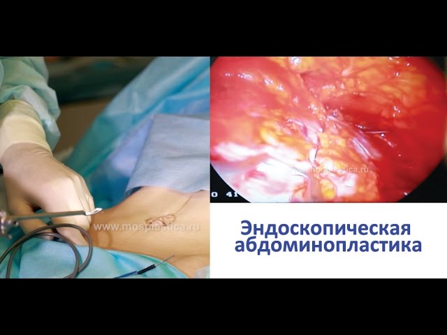 Эндоскопическая абдоминопластика. Тимур Кобулашвили