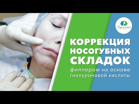 Коррекция носогубных складок филлером на основе гиалуроновой кислоты