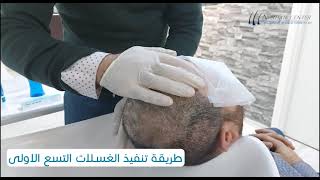  طريقة تنفيذ الغسلات التسع الاولى بعد عملية زراعة الشعر 