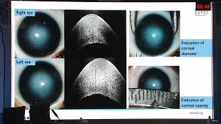 AIOC 2026 - IC205 - Dr.Muralidhar Ramappa Structural Corneal Changes in Cyp1b1-related Congenit..