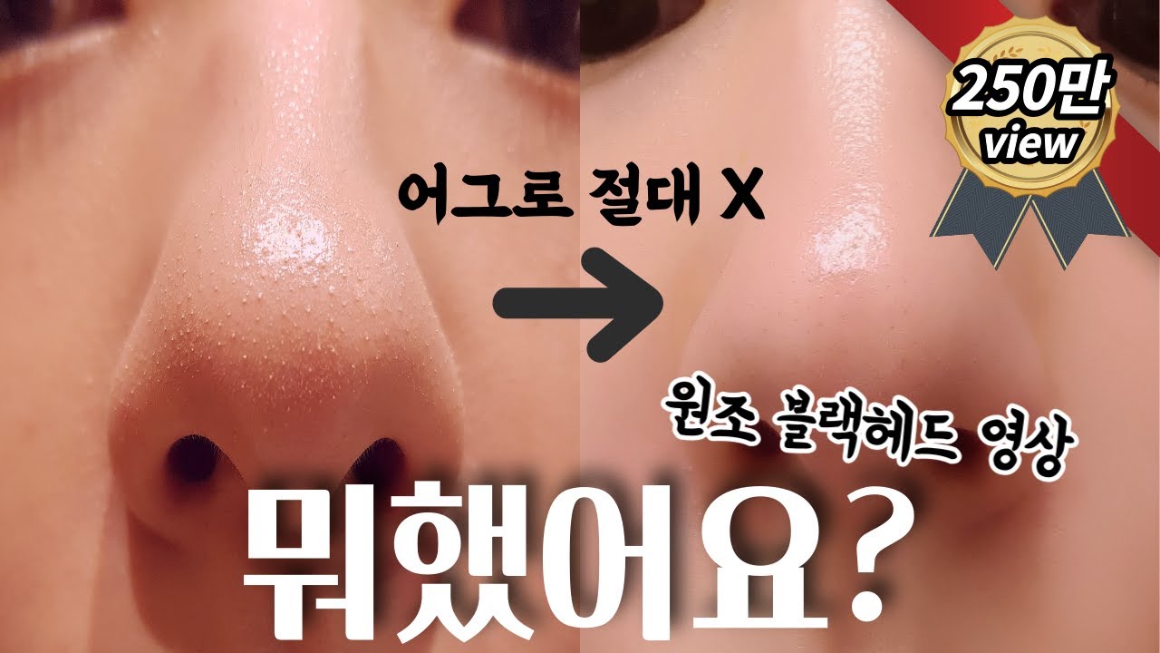 블랙헤드 제거 확실하게 하는 방법👃피부과 안가고 집에서 블랙헤드 없애기❗