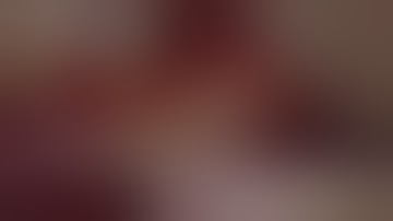 Split Crest Technique - 2 stage approach