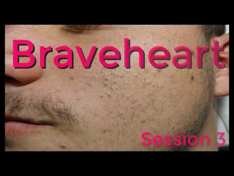 extraction-for-teenage-acne:-session-3--part-i