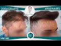 Hair Graft Technique FUE - 2.006 Grafts (4.905 Hairs) - Dr. Rafael de Freitas