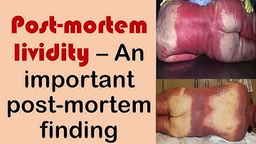 Postmortem lividity - An important postmortem change