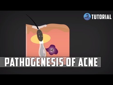 Acne Pathophysiology | Acne Vulgaris (Pimples) Pathogenesis