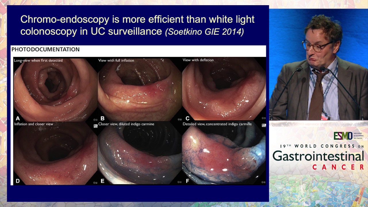 IBD-related GI cancers: Are they different?