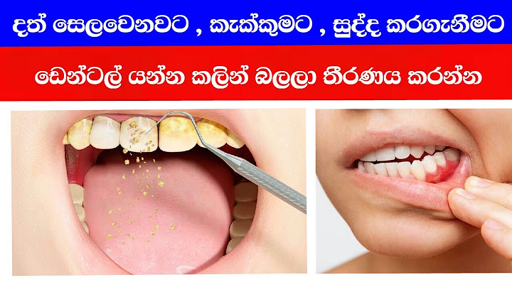 දත් | දත් කැක්කුකම | Teeth | Dath Kakkumata | Dath Sudda Karanna | දත් සෙලවනවට | දත් සුද්ද කිරීම