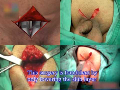 Penis Surgery Videos 9