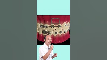 Niềng răng thưa như thế nào? #niengrang #drphungkhoa #nhakhoakhoadat #shorts