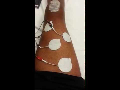 Video: Helpt elektrotherapie tendinitis?