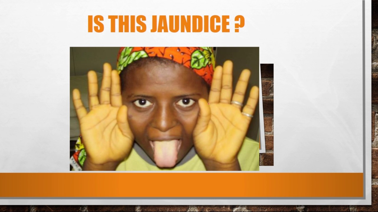 Jaundice: Molecular Basis camera iphone 8 plus apk