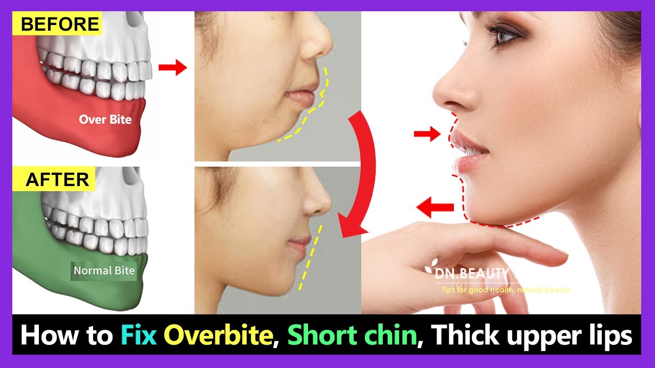 7 Steps How To Fix Overbite, Small Chin, Big Thick Upper Lip Without Braces Naturally.