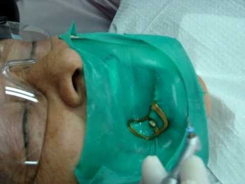 endodoncia tratamientos paso 5 - Dr. martin vargas