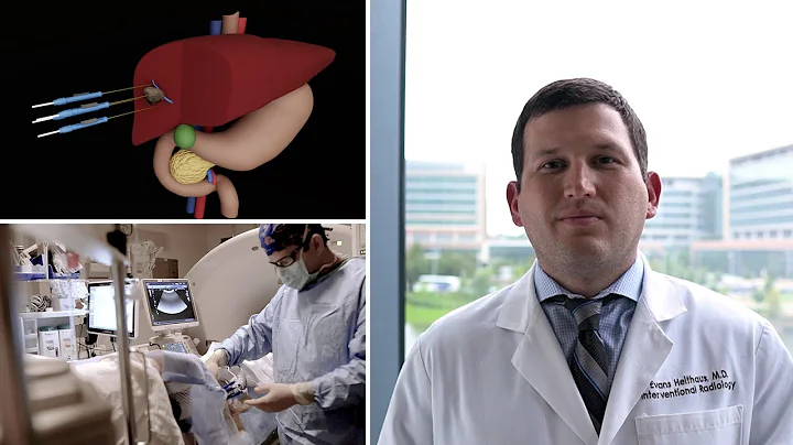 Dr.  Robert Evans Heithaus Explains NanoKnife