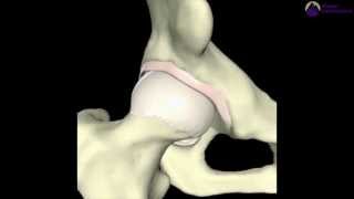 Pincer-Type Femoroacetabular Impingement (FAI)