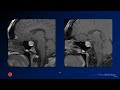 Neuroradiology board review 3 case 7