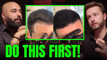 Instantly Double Your Hair Density With Scalp Micro Pigmentation!
